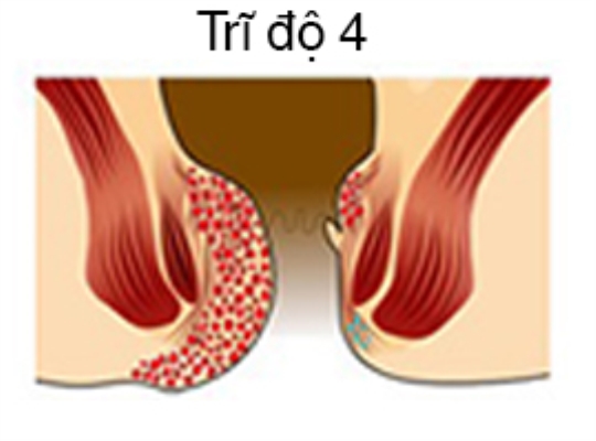bệnh trĩ cấp độ 4